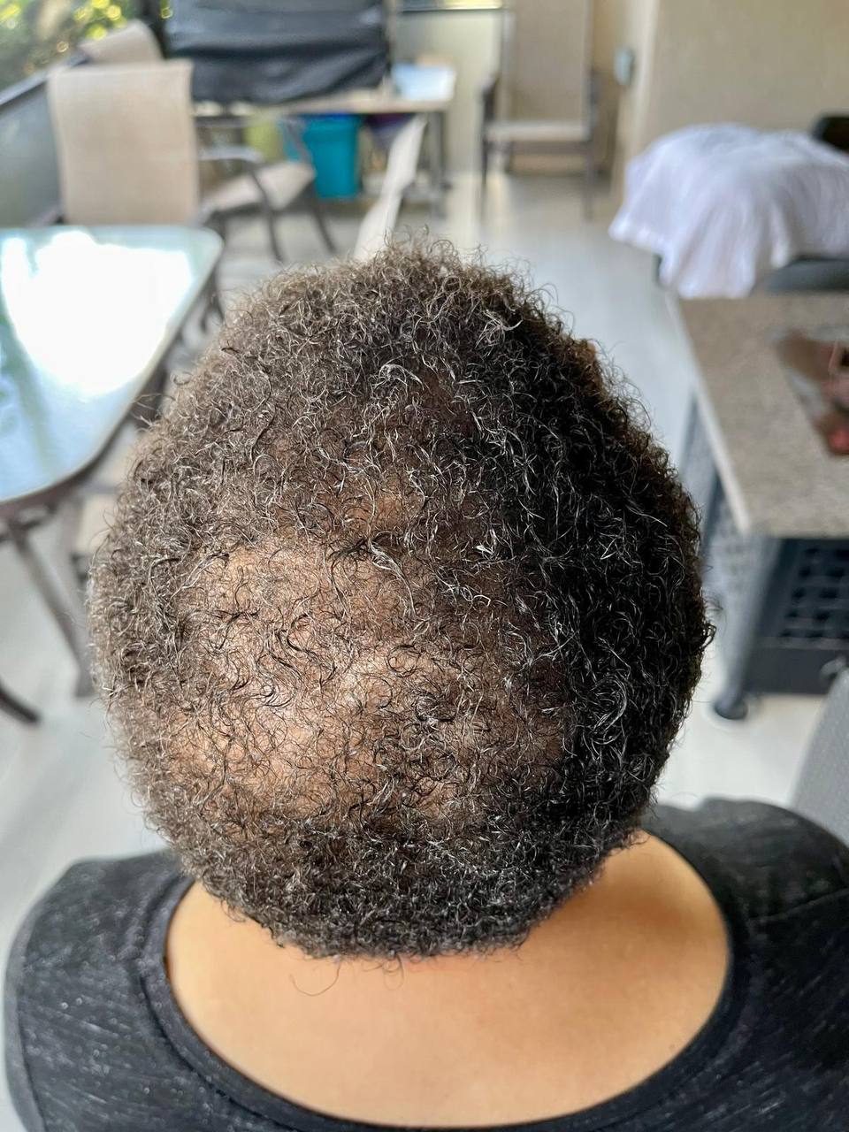 Customer photo showing hair thinning at the crown